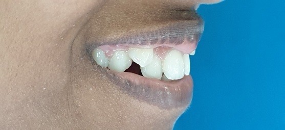 Before Dental Image