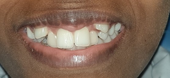 Before Dental Image
