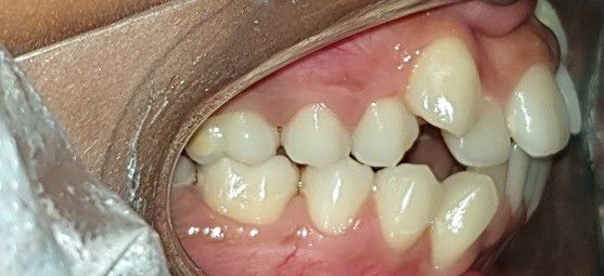 Before Dental Image