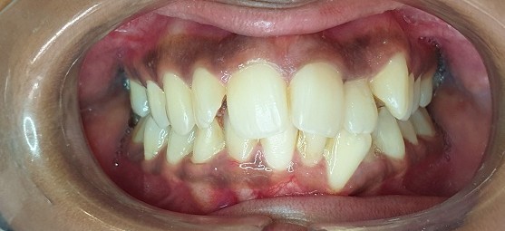 Before Dental Image