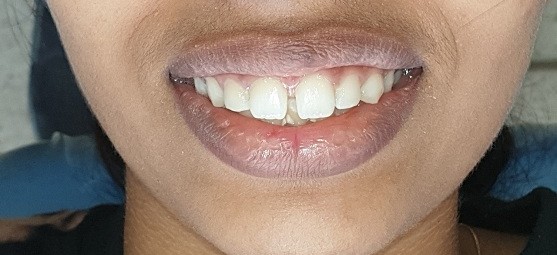 Before Dental Image