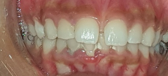 Before Dental Image